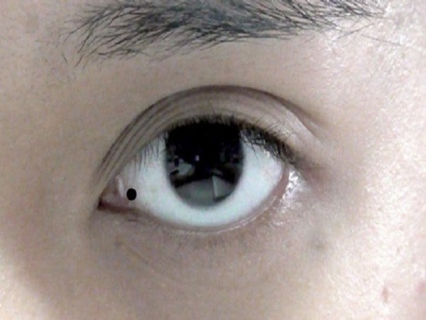Nốt ruồi trong mắt nói lên điều gì ở con người? 